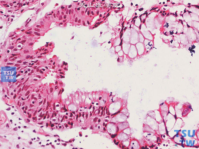 腺性膀胱炎，伴肠腺型化生，示向肠上皮化生移行（上图高倍）