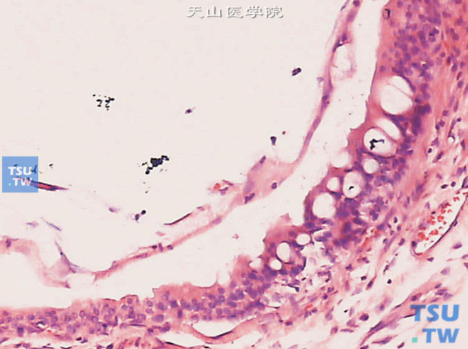 腺性膀胱炎伴肠腺型化生，示可见少数肠腺型细胞