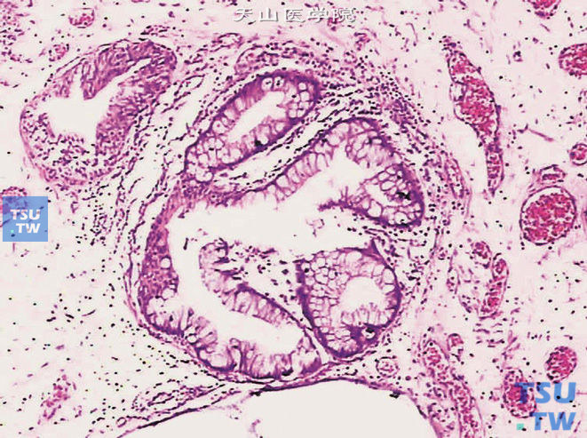 腺性膀胱炎伴肠腺型化生，图中腺体大部分为肠腺型细胞