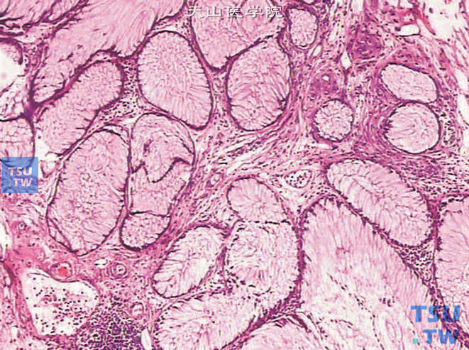 腺性膀胱炎，肠腺型化生，图中腺体全部为肠腺型细胞
