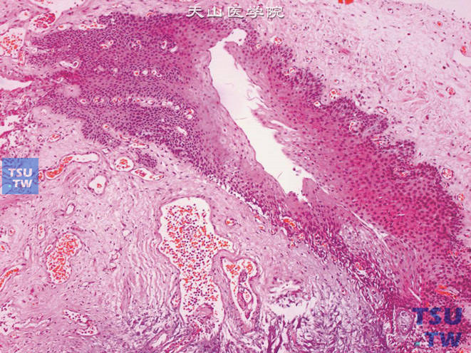 膀胱黏膜被覆上皮鳞化，局部下陷形成微小囊肿