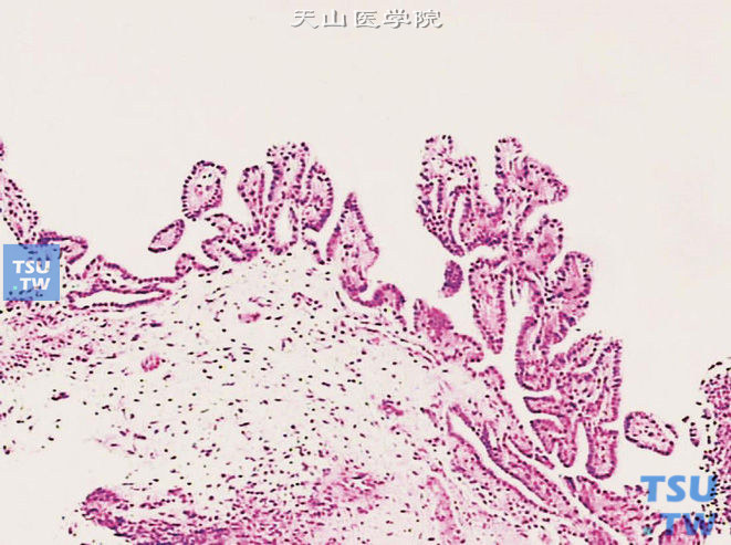 膀胱黏膜腺瘤样化生（肾源性化生），示黏膜表面的小乳头或息肉样改变