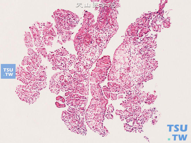 （膀胱活检）腺瘤样化生（肾源性腺瘤），位于黏膜表面的呈乳头状结构，细胞呈钉突状，此形态需与乳头状尿路上皮癌鉴别