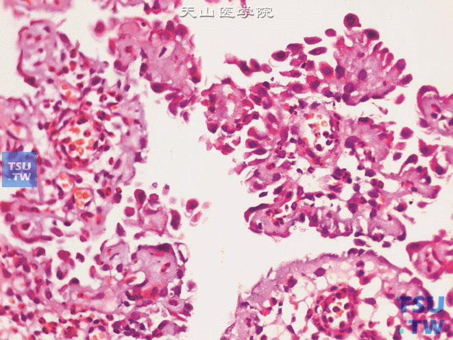 （膀胱活检）腺瘤样化生（肾源性腺瘤），位于黏膜表面的呈乳头状结构，细胞呈钉突状，高倍镜下细胞核可见异型性