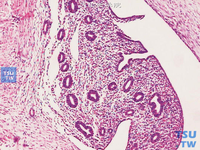 膀胱子宫内膜异位症，膀胱黏膜层可见子宫内膜腺体及间质
