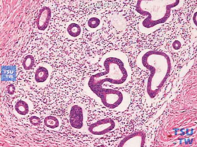 膀胱子宫内膜异位症，膀胱肌层内有大小不等的腺管及腺腔，周围围绕以子宫内膜间质