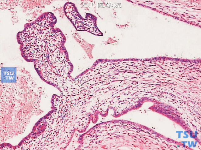 膀胱子宫内膜异位症，示肌层中扩张的囊状结构