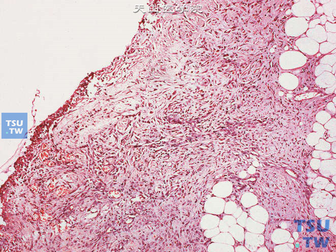 手术后肉芽肿性病变，膀胱黏膜局部组织缺损，可见增生的梭形细胞，纵横交错排列
