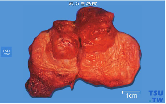 膀胱炎性假瘤病理图谱