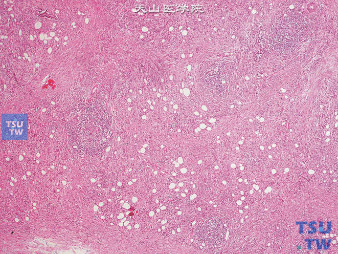 膀胱炎性假瘤。可见增生的梭形细胞及大量炎细胞浸润