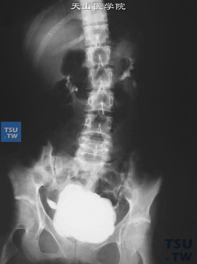 膀胱结石（IVP），显示膀胱内结石所致的充盈缺损
