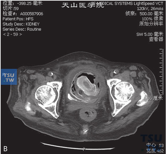 图B：CT，膀胱结石，男，45岁，尿道外伤后膀胱插管1年余。膀胱内见一不均匀高密度灶，中央见高密度灶，周围见气体及软组织密度灶。膀胱壁增厚、毛糙