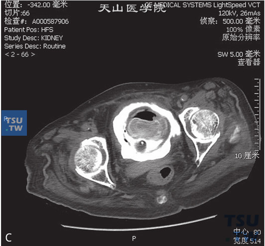 图C：CT，膀胱结石，男，45岁，尿道外伤后膀胱插管1年余。膀胱内见一不均匀高密度灶，中央见高密度灶，周围见气体及软组织密度灶。膀胱壁增厚、毛糙