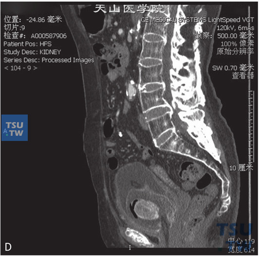 图D：CT，膀胱结石，男，45岁，尿道外伤后膀胱插管1年余。膀胱内见一不均匀高密度灶，中央见高密度灶，周围见气体及软组织密度灶。膀胱壁增厚、毛糙