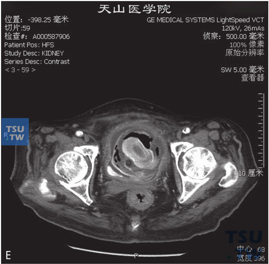 图E：CT，膀胱结石，男，45岁，尿道外伤后膀胱插管1年余。膀胱内见一不均匀高密度灶，中央见高密度灶，周围见气体及软组织密度灶。膀胱壁增厚、毛糙