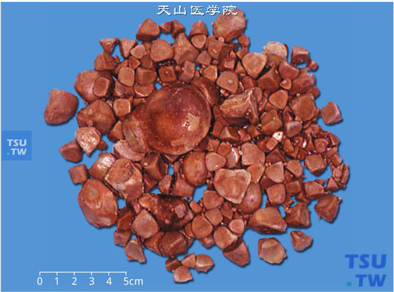 膀胱结石病理图谱