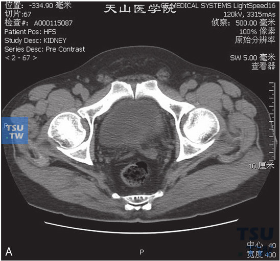 图A：CT，膀胱乳头状瘤，男，66岁，血尿；膀胱左侧壁见一结节状软组织密度灶以窄基底与膀胱壁相连，边缘光整，增强后可见强化