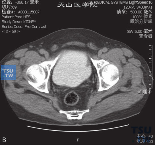 图B：CT，膀胱乳头状瘤，男，66岁，血尿；膀胱左侧壁见一结节状软组织密度灶以窄基底与膀胱壁相连，边缘光整，增强后可见强化