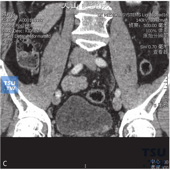 图C：CT，膀胱乳头状瘤，男，66岁，血尿；膀胱左侧壁见一结节状软组织密度灶以窄基底与膀胱壁相连，边缘光整，增强后可见强化