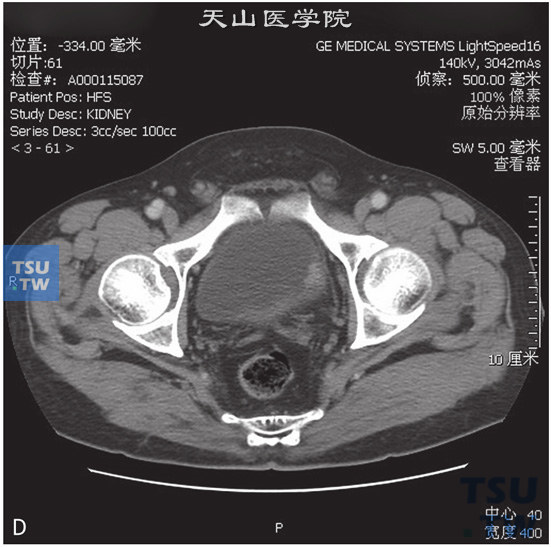 图D：CT，膀胱乳头状瘤，男，66岁，血尿；膀胱左侧壁见一结节状软组织密度灶以窄基底与膀胱壁相连，边缘光整，增强后可见强化