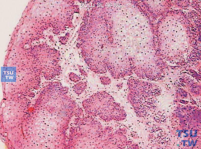 膀胱鳞状细胞乳头状瘤