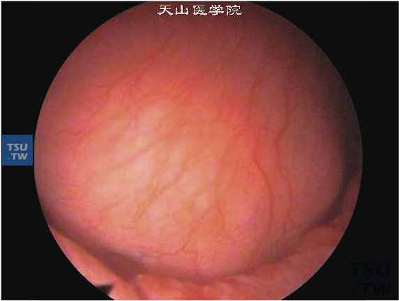 膀胱尿路上皮内翻性乳头状瘤病理图谱