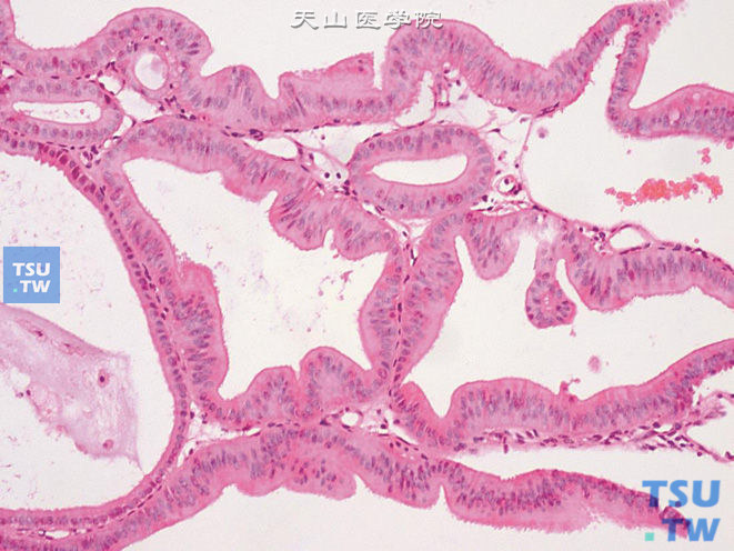 膀胱绒毛状腺瘤（该病例基底部恶变呈腺癌表现），示被覆假复层纤毛柱状上皮