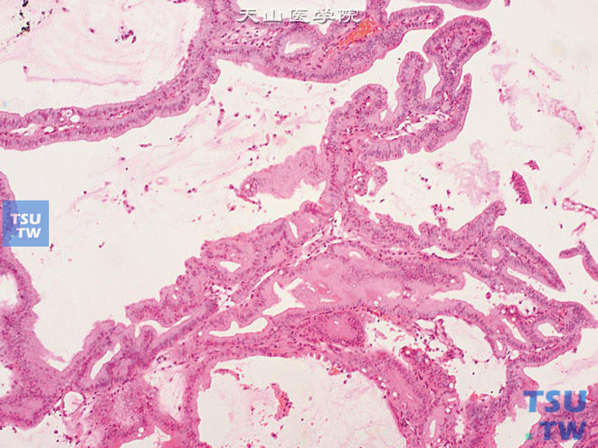 膀胱绒毛状腺瘤（该病例基底部恶变呈腺癌表现），示乳头状结构