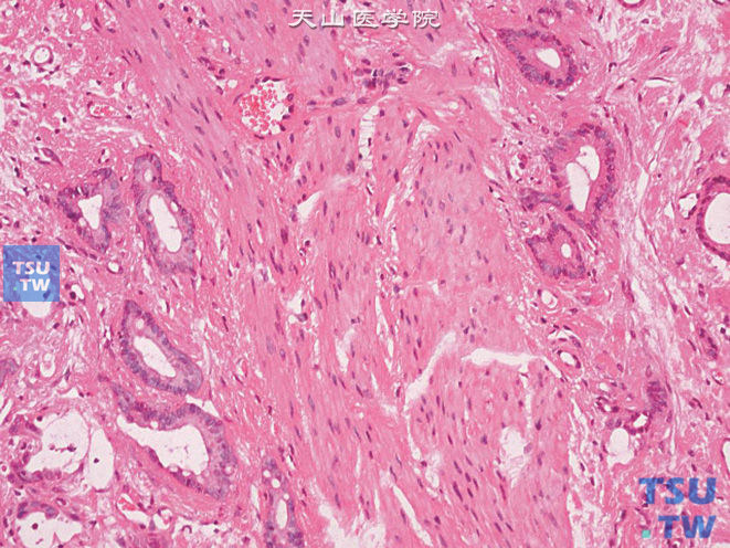 膀胱绒毛状腺瘤，基底部恶变呈腺癌表现，示肌层浸润的腺体上皮细胞呈柱状