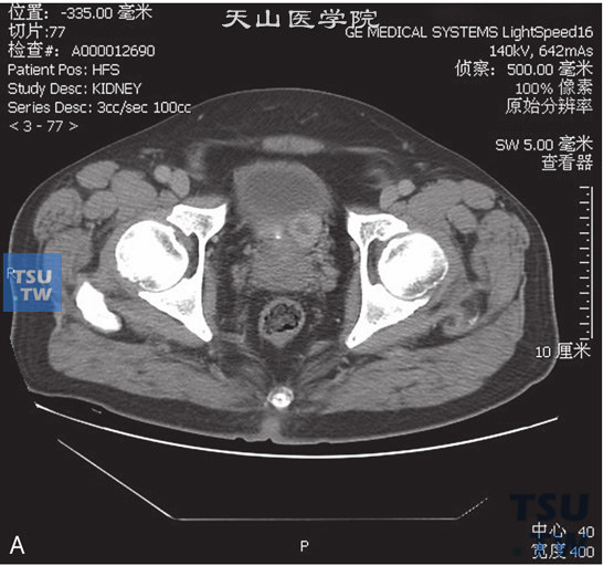 图A：膀胱嗜铬细胞瘤，男，25岁，排尿后多次晕倒。膀胱左下壁见一软组织密度占位，边缘清晰，增强后动脉期明显强化，中央见无强化坏死区；静脉期呈稍高密度