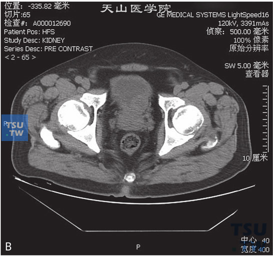 图B：膀胱嗜铬细胞瘤，男，25岁，排尿后多次晕倒。膀胱左下壁见一软组织密度占位，边缘清晰，增强后动脉期明显强化，中央见无强化坏死区；静脉期呈稍高密度