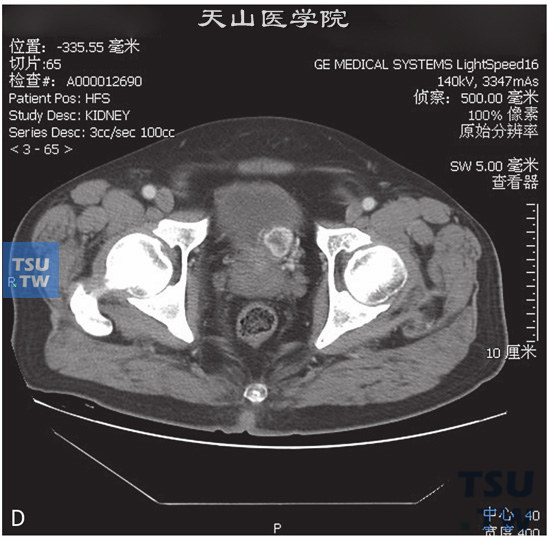 图D：膀胱嗜铬细胞瘤，男，25岁，排尿后多次晕倒。膀胱左下壁见一软组织密度占位，边缘清晰，增强后动脉期明显强化，中央见无强化坏死区；静脉期呈稍高密度