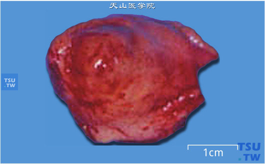 膀胱副神经节瘤。肿瘤局限性生长，分叶状，外观呈淡红或黄褐色（大体）