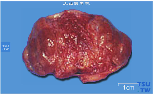 膀胱副神经节瘤。肿瘤局限性生长，分叶状，外观呈淡红或黄褐色（切面）