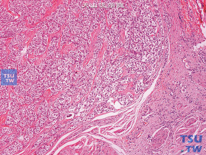 膀胱嗜铬细胞瘤，肿瘤与周围组织界限清楚
