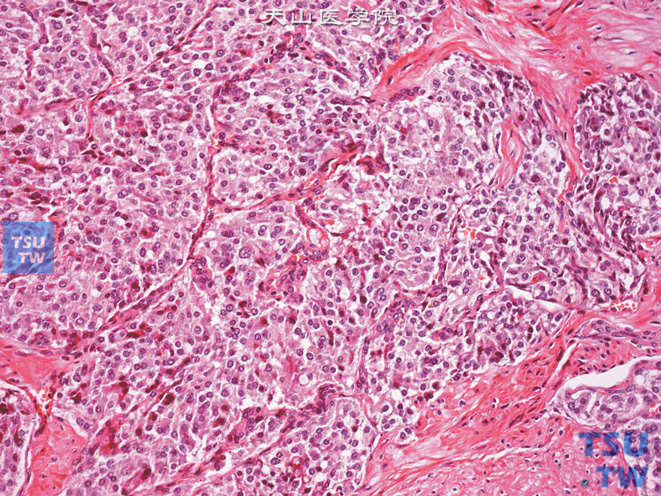 膀胱嗜铬细胞瘤，细胞巢间由血管网分隔。瘤细胞圆形，胞质透明、嗜酸或嗜碱性。细胞核卵圆形