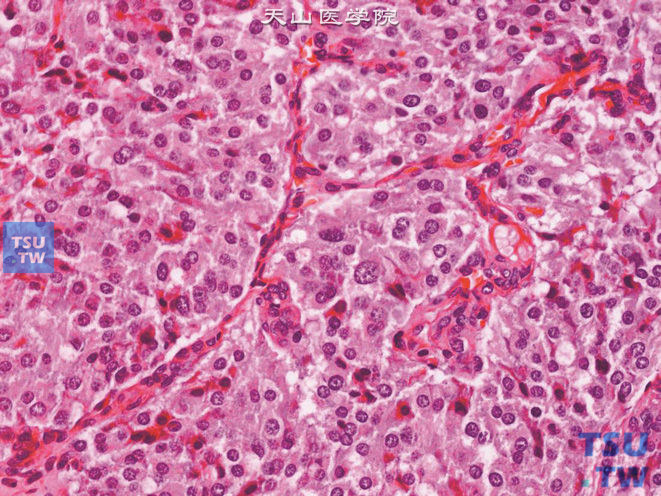 膀胱嗜铬细胞瘤，可见散在分布的大核细胞