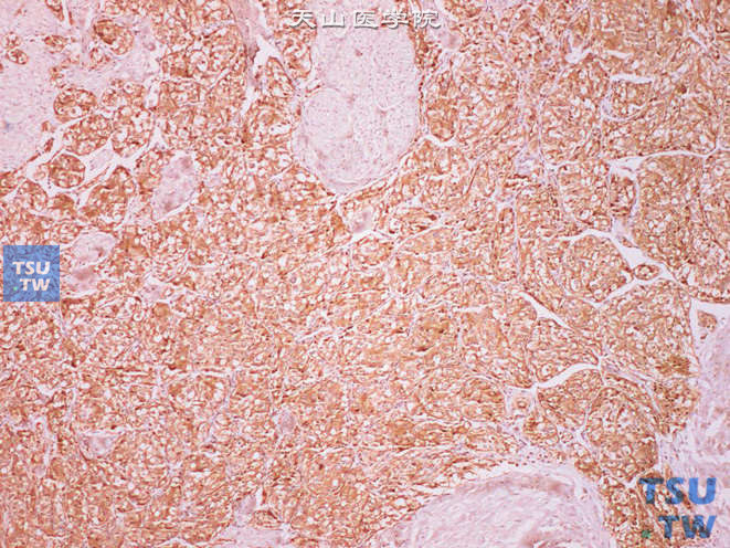 膀胱嗜铬细胞瘤，Syn（+）
