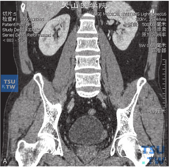 图A：CT，膀胱平滑肌瘤，男，38岁，血尿；膀胱左侧壁见以结节状软组织密度灶，分别向膀胱内外突出，增强后轻度强化，膀胱内壁光整