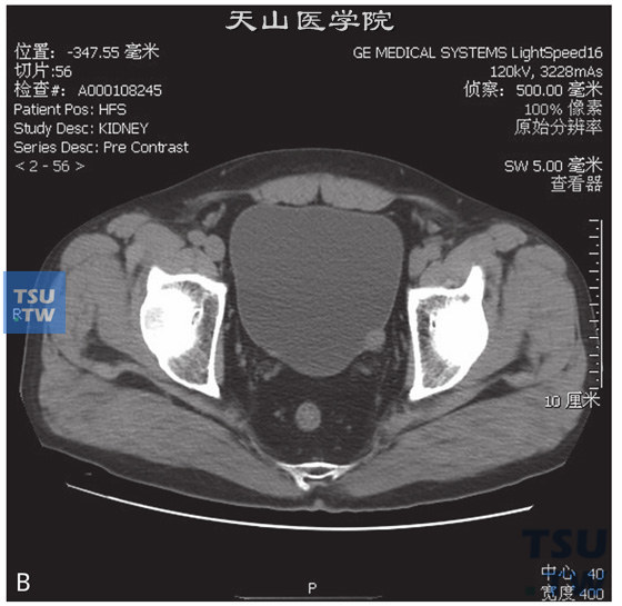 图C：CT，膀胱平滑肌瘤，男，38岁，血尿；膀胱左侧壁见以结节状软组织密度灶，分别向膀胱内外突出，增强后轻度强化，膀胱内壁光整
