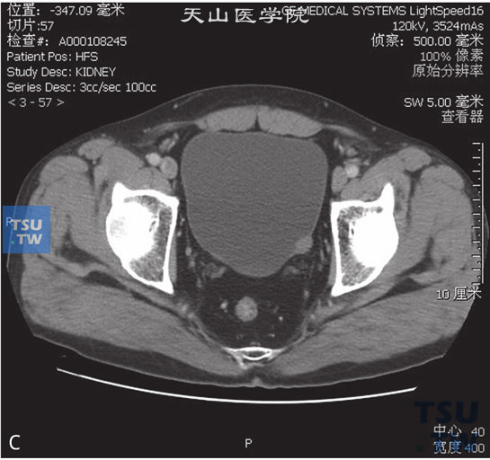 图B：CT，膀胱平滑肌瘤，男，38岁，血尿；膀胱左侧壁见以结节状软组织密度灶，分别向膀胱内外突出，增强后轻度强化，膀胱内壁光整