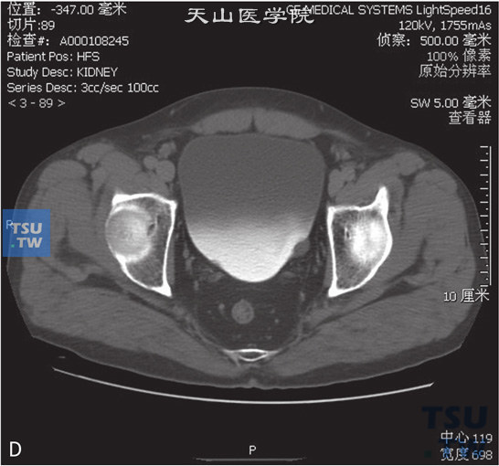 图D：CT，膀胱平滑肌瘤，男，38岁，血尿；膀胱左侧壁见以结节状软组织密度灶，分别向膀胱内外突出，增强后轻度强化，膀胱内壁光整