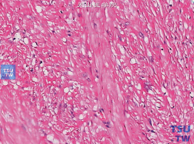 膀胱平滑肌瘤，由成束的平滑肌细胞构成，胞质嗜酸，核异型性及核分裂象极少或无