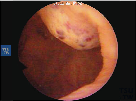 膀胱血管瘤（膀胱镜）。可见紫红色、分叶状有蒂的肿物
