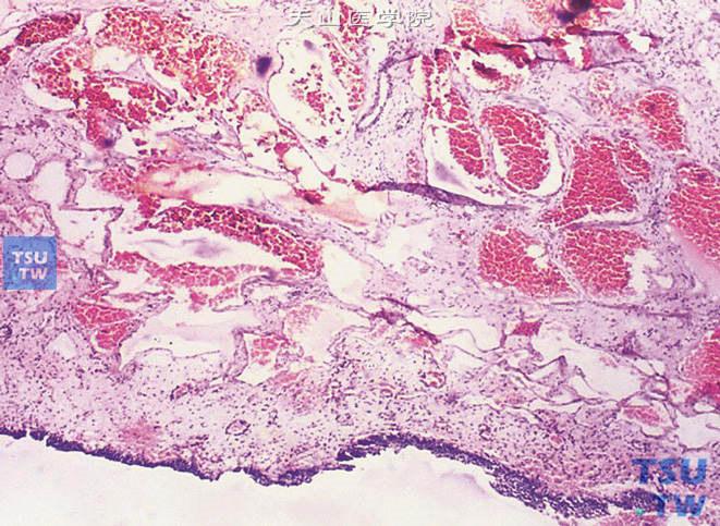 膀胱海绵状血管瘤，瘤组织为含血液的血管腔隙