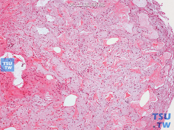 膀胱海绵状血管瘤，位于黏膜层