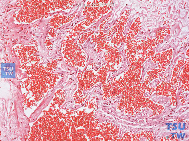 膀胱黏膜血管瘤，示血管结构融合，被覆扁平上皮