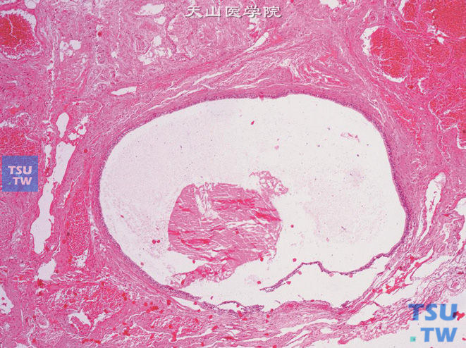 膀胱黏膜血管瘤，与腺性膀胱炎（局部呈囊性扩张）伴发