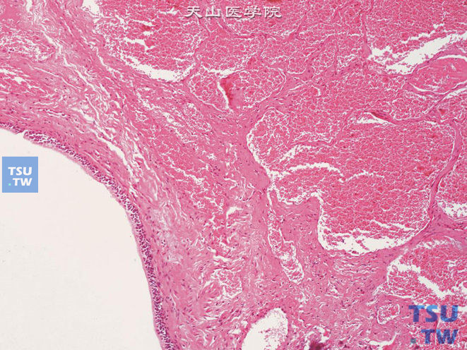 膀胱黏膜血管瘤，与腺性膀胱炎（左下方）伴发