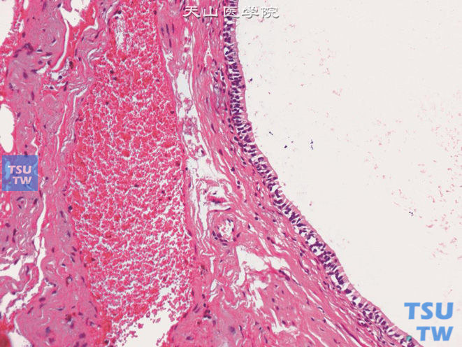 膀胱黏膜血管瘤，与腺性膀胱炎伴发，示腺性膀胱炎病变的被覆上皮呈分泌性上皮表现
